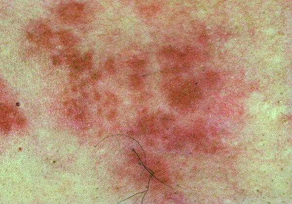 Знакомьтесь с инфекционными заболеваниями наружных покровов