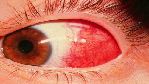 Поражение глаз при клещевом боррелиозе лайма