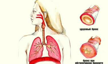 Почему при пневмонии тяжело дышать