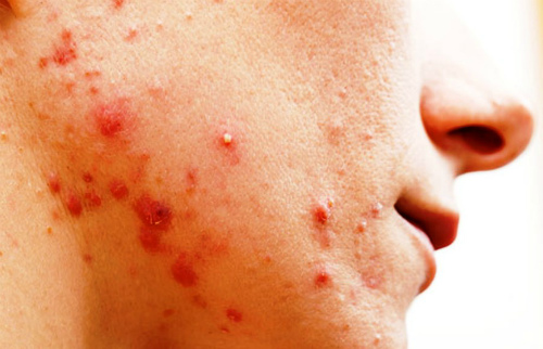 Какие симптомы при золотистом стафилококке на коже